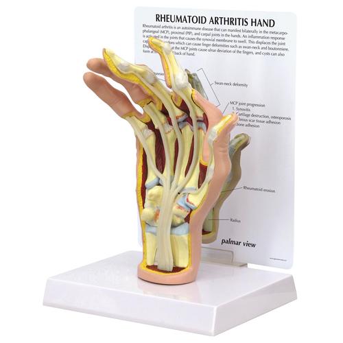 Modelo de Mão com Artrite Reumatoide, 1019521, Modelos de esqueletos do braço e mão