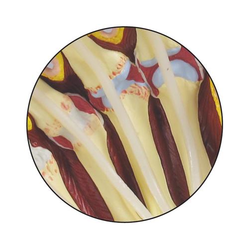 Modelo de Mão com Artrite Reumatoide, 1019521, Modelos de esqueletos do braço e mão