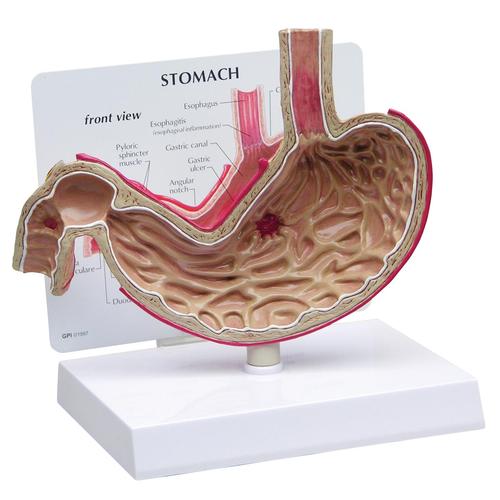 Modelo de Estômago com Úlceras, 1019523, Modelo de sistema digestivo