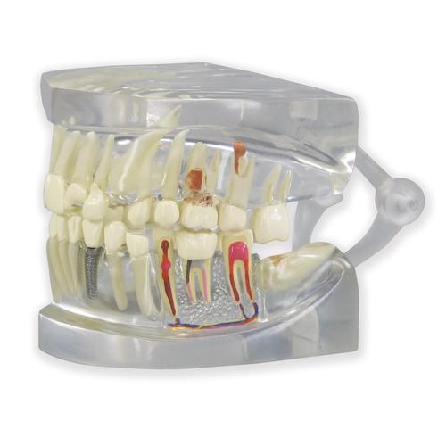 Modelo de Mandíbula Humana Translúcida com Dentes, 1019540, Modelos dentais