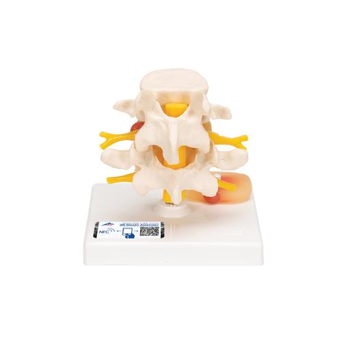 Coluna vertebral lombar com discos intervertebrais prolapsos, 1000149 [A76], Modelos de vértebras