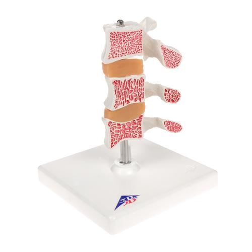 Modelo de osteoporose de luxo (3 Vértebras), 1000153 [A78], Informações sobre artrite e osteoporose