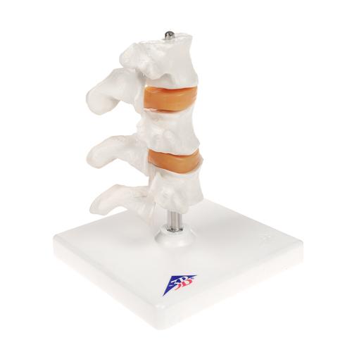 Modelo de osteoporose de luxo (3 Vértebras), 1000153 [A78], Informações sobre artrite e osteoporose