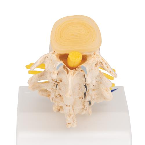 Estágios de hérnia de disco e degeneração das vértebras, 1000158 [A795], Modelos de vértebras
