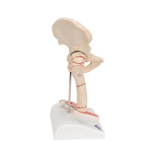 Fratura do fêmur e artrose da articulação coxofemoral, 1000175 [A88], Informações sobre artrite e osteoporose