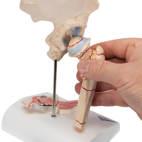 Fratura do fêmur e artrose da articulação coxofemoral, 1000175 [A88], Modelo de articulações