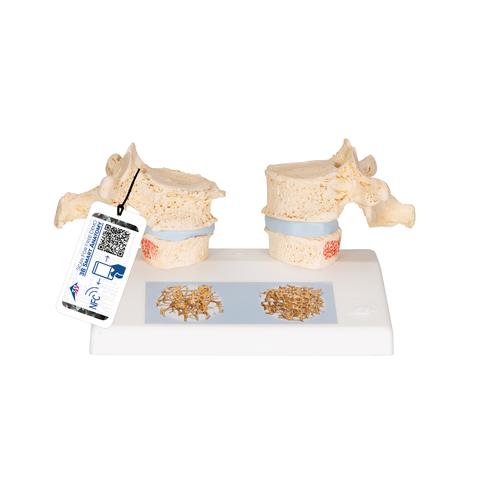 Modelo de osteoporose, 1000182 [A95], Modelos de vértebras
