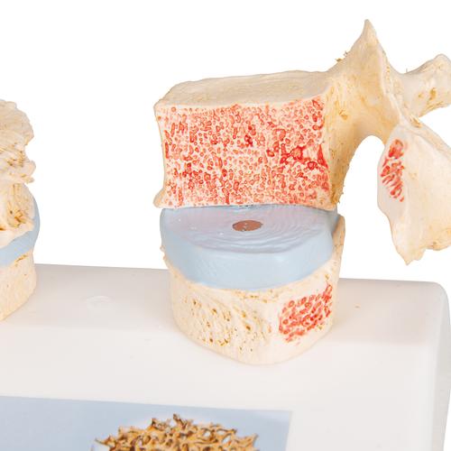 Modelo de osteoporose, 1000182 [A95], Modelos de vértebras