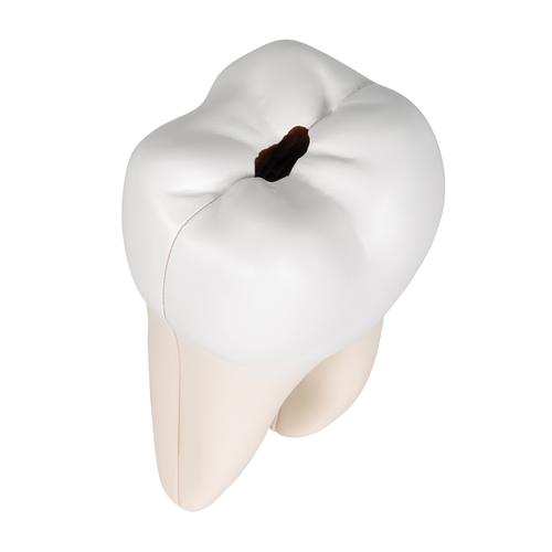 Molar inferior com raiz dupla, inserção de cáries, 2 partes, 1000243 [D10/4], Modelos dentais