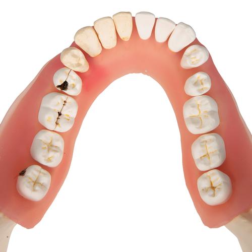 Doença dental, ampliado 2 vezes, em 21 partes, 1000016 [D26], Modelos dentais