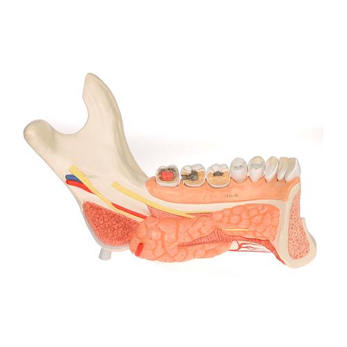 Metade inferior de mandíbula avançada com adição de 8 dentes cariados, 19 partes, 1001250 [VE290], Modelos dentais