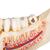 Doença dental, ampliado 2 vezes, em 21 partes, 1000016 [D26], Modelos dentais (Small)
