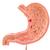Estômago com úlceras gástricas, 1000304 [K17], Modelo de sistema digestivo (Small)